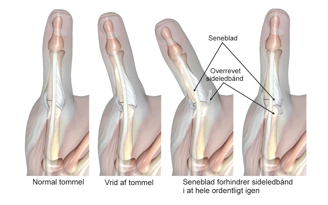 Illustration af en normal tommelfinger og en skadet tommelfinger.