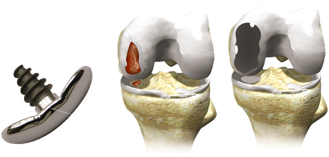 HemiCAP knæprotese.