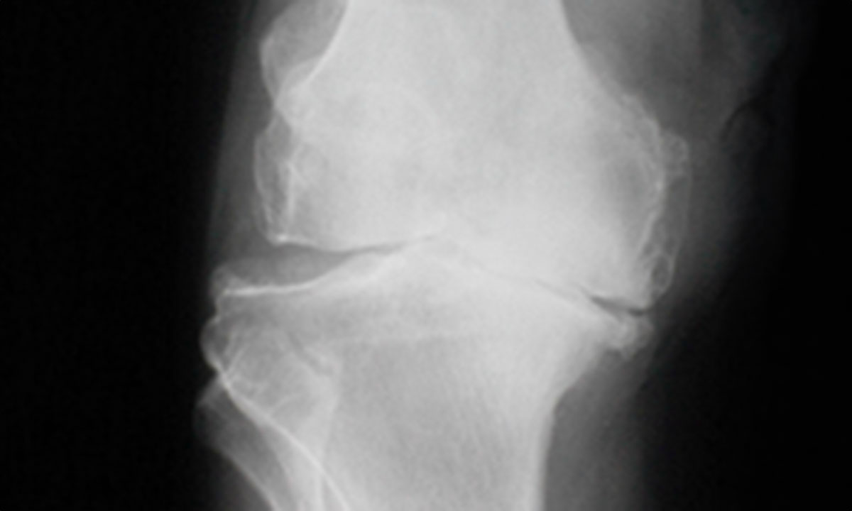 Røntgenbillede af slidgigt i knæet.
