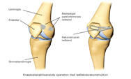 Illustration af knæskalsstabiliserende operation med ledbåndsrekonstruktion.