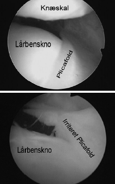 Slimhindefold irritation ved lårbensknoglen og knæskallen.