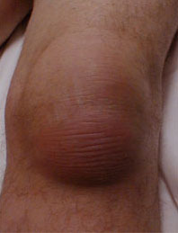 Billede af et knæ med slimsækbetændelse.