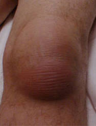 Billede af et knæ med slimsækbetændelse.