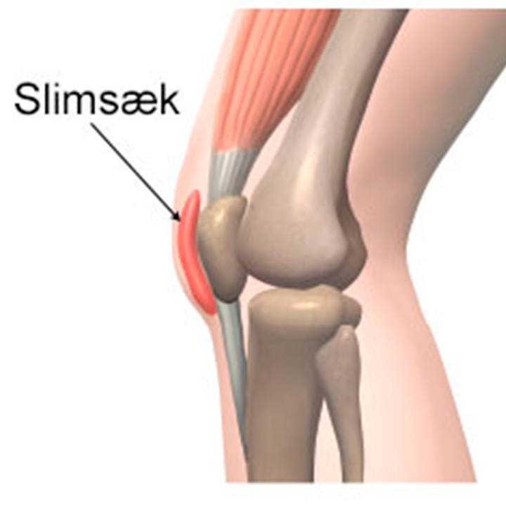 Illustration af slimsækbetændelse ved knæet.