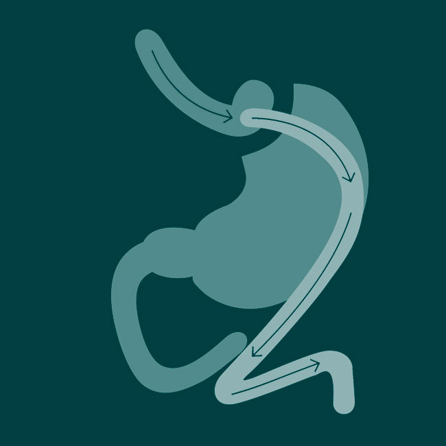 En stor illustration af gastric bypass operation.