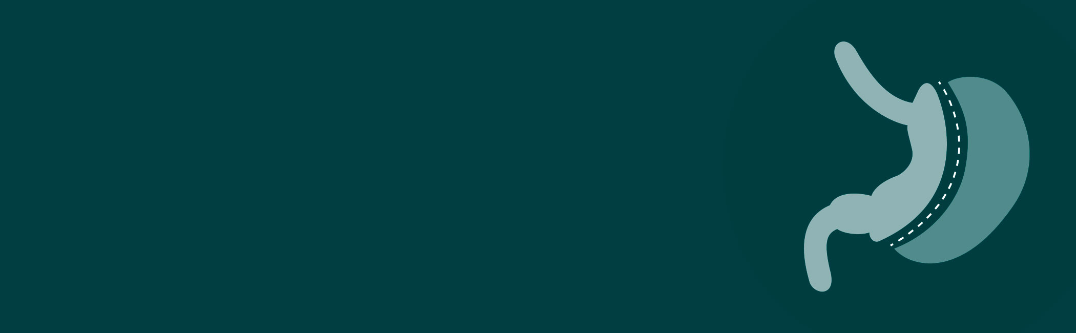 En stor illustration af gastric sleeve operation.