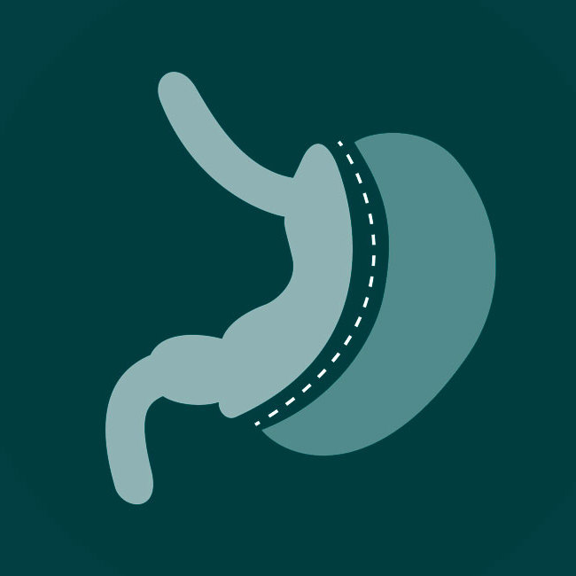 En stor illustration af gastric sleeve operation.