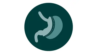 En lille illustration af gastric sleeve operation.