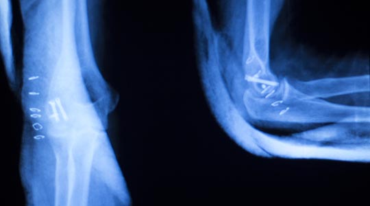Røntgenbillede af en albue.