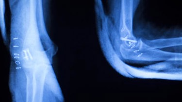 Røntgenbillede af en albue.