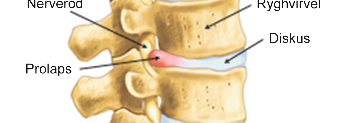 Illustration af diskusprolaps set fra siden.