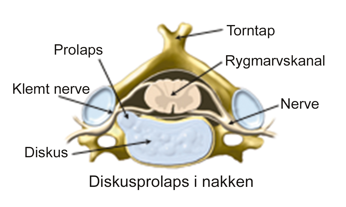 Illustration af diskusprolaps i nakken.