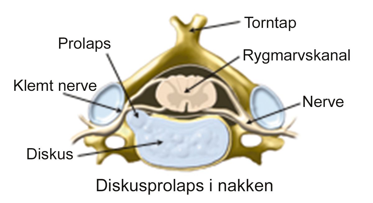 Illustration af diskusprolaps i nakken.