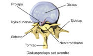 Illustration af diskusprolaps set ovenfra.