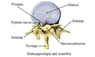 Illustration af diskusprolaps set ovenfra.