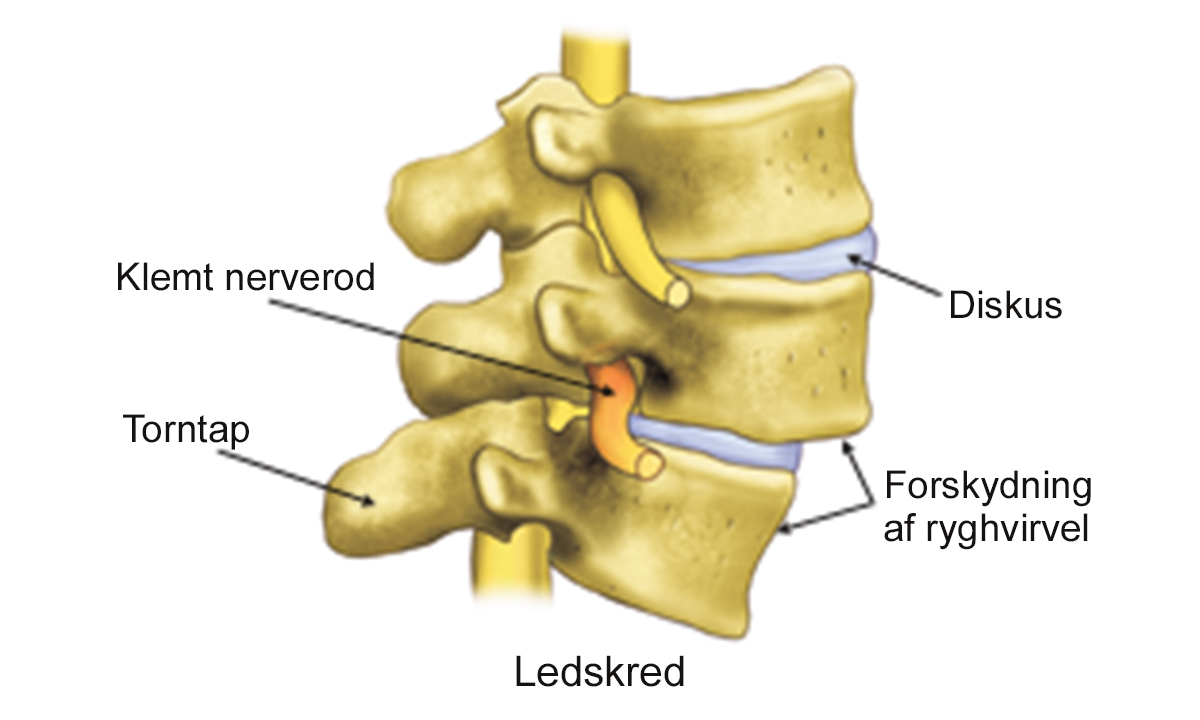 Illustration af ledskred i ryggen.