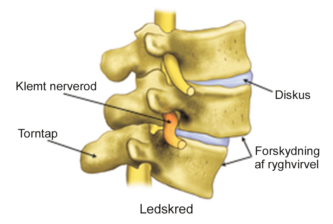 Illustration af ledskred i ryggen.
