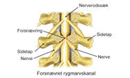 Illustration af spinalstenose i lænden.