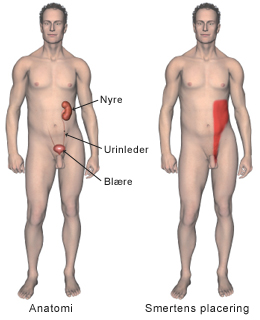 Nyresten anatomi og smertens placering.