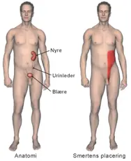 Nyresten anatomi og smertens placering.