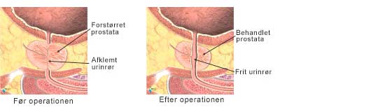 Et billede af forstørret prostata før og efter operationen.